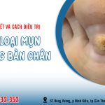 Cách điều trị các loại mụn ở lòng bàn chân