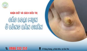 Cách điều trị các loại mụn ở lòng bàn chân