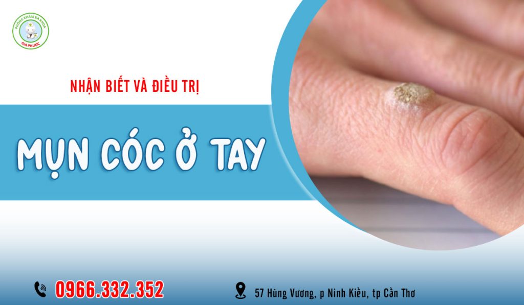 Cách trị mụn cóc ở tay