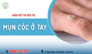 Cách trị mụn cóc ở tay