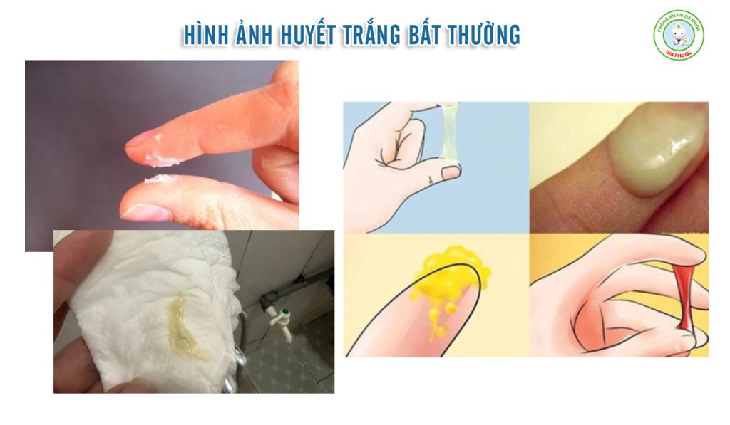 Hình ảnh huyết trắng bệnh lý dễ nhận biết