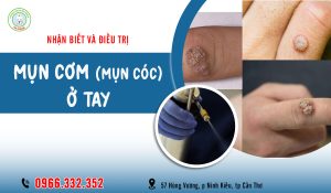 Mụn cơm ở tay là gì? Cách trị mụn cơm ở tay hiệu quả