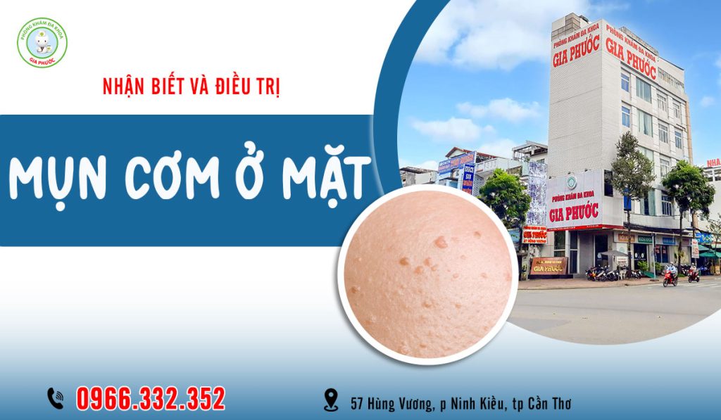 Khám và điều trị mụn cơm ở mặt hiệu quả tại phòng khám đa khoa Gia Phước