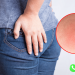 Áp Xe Mông: Triệu Chứng, Nguyên Nhân, Cách Trị Hiệu Quả 12 Áp xe mông