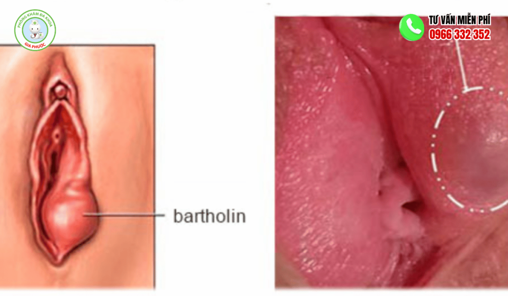 Tuyến Bartholin Nằm Ở Đâu? Cấu Tạo Và Chức Năng 3 Bệnh lý tuyến bartholin phổ biến