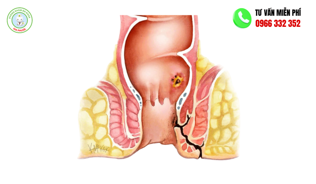 Bệnh mạch lươn