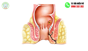 Bệnh mạch lươn