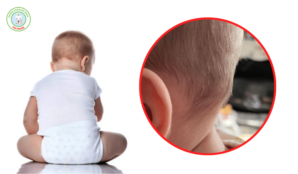 Trẻ Nổi Hạch Sau Đầu: Nguyên Nhân Và Cách Trị Hiệu Quả 2 Bệnh nổi hạch sau đầu ở trẻ