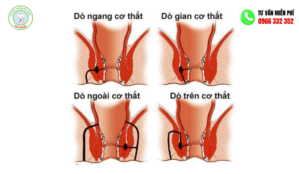 Bệnh rò hậu môn là gì
