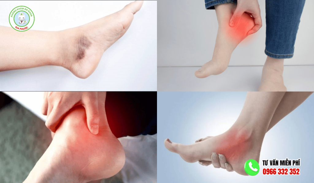 Cách Điều Trị Mắt Cá Chân Bị Sưng Hiệu Quả Nhất