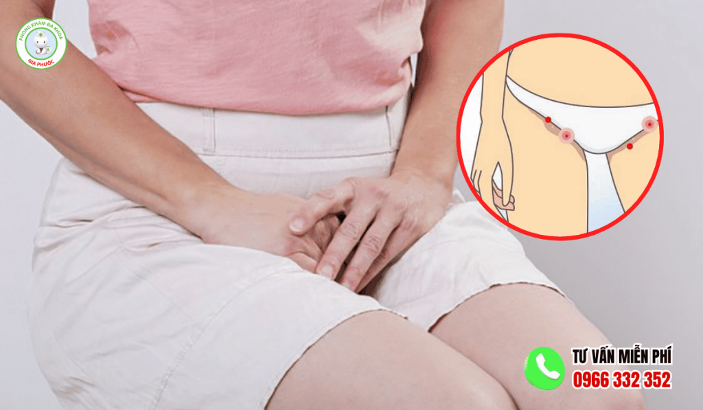 Cách Trị Ngứa 2 Bên Mép Vùng Kín Tại Nhà An Toàn Hiệu Quả 2 Cách trị ngứa 2 bên mép vùng kín tại nhà