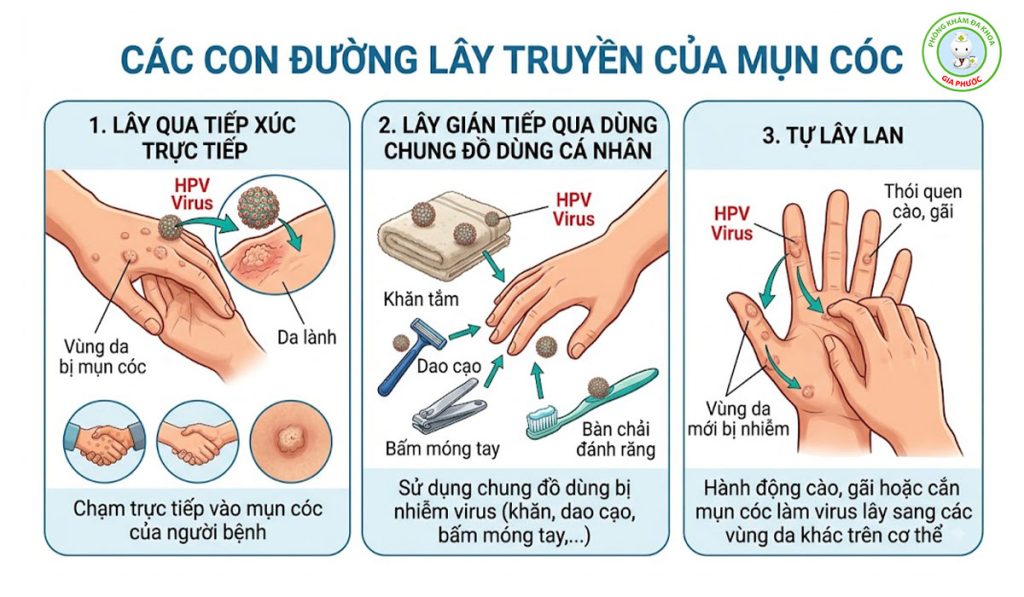 Mụn cóc có lây không?