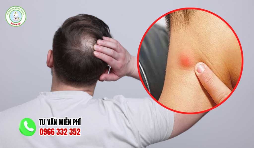 Nổi cục sau gáy không đau
