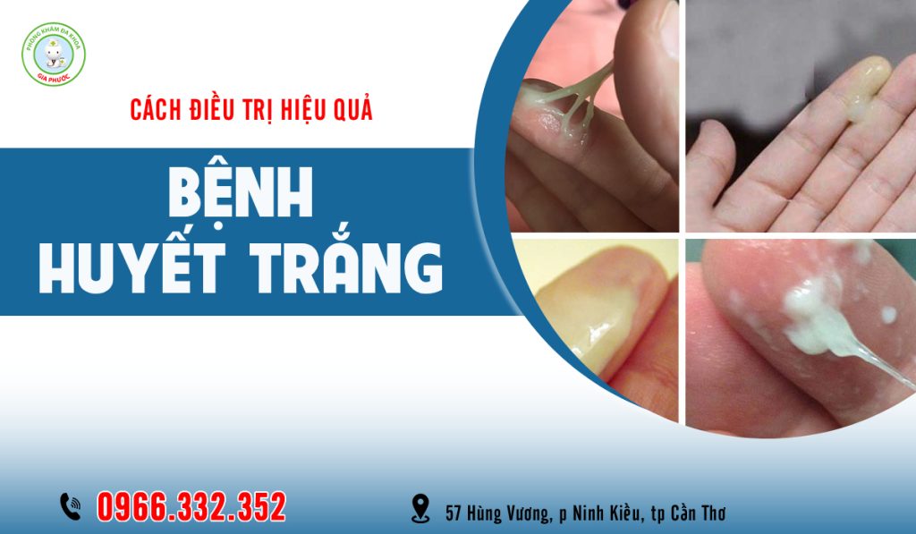 Cách chữa bệnh huyết trắng hiệu quả