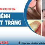 Cách Chữa Bệnh Huyết Trắng Hiệu Quả, Chuẩn Y Khoa & Ngăn Ngừa Tái Phát 7 Cách chữa bệnh huyết trắng hiệu quả
