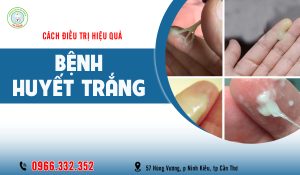 Cách chữa bệnh huyết trắng hiệu quả