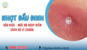 Cách chữa nhọt đầu đinh hiệu quả