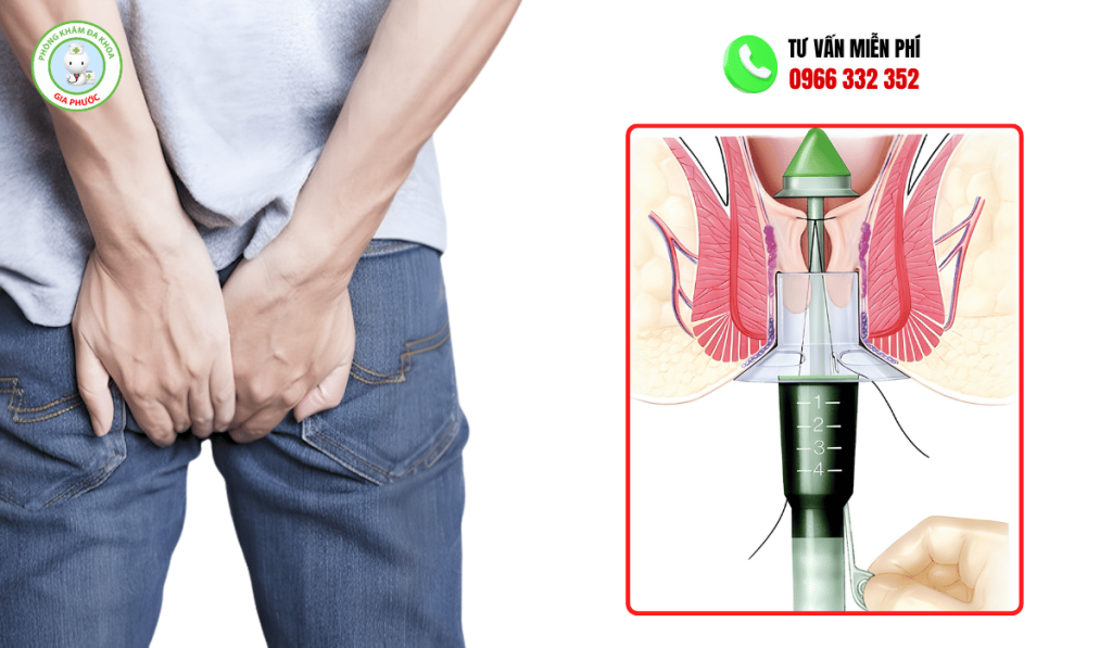 Cắt Trĩ Longo Bao Nhiêu Tiền, Ở Đâu Tốt Nhất? Bảng Giá Chi Tiết 1 Cắt trĩ bằng longo bao nhiêu tiền