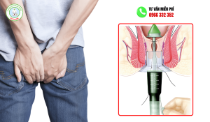Cắt trĩ bằng longo bao nhiêu tiền