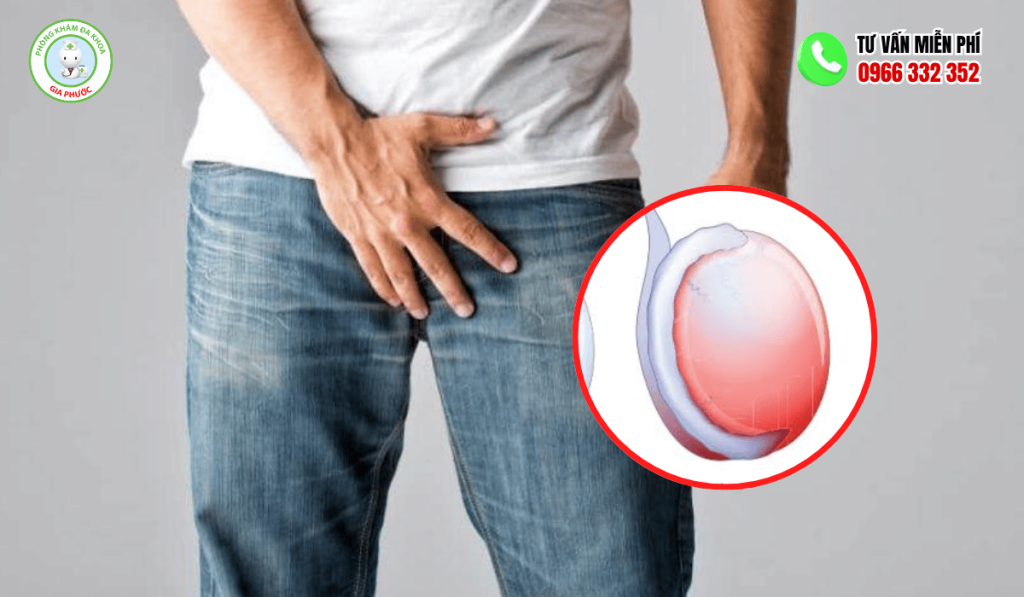Đau Tinh Hoàn Bên Phải: Dấu Hiệu Cảnh Báo, Nguyên Nhân & Cách Điều Trị 1 Đau tinh hoàn bên phải