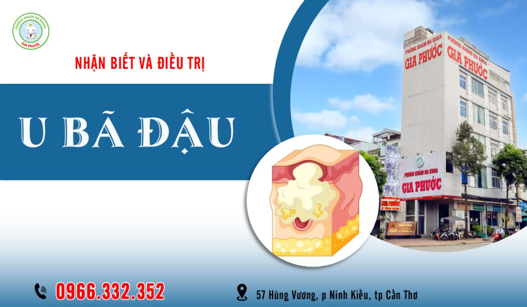 U Bã Đậu Ở Bộ Phận Sinh Dục Trẻ Nhỏ: Dấu Hiệu, Nguy Hiểm & Cách Xử Lý An Toàn 3 Phòng khám đa khoa Gia Phước - Địa chỉ khám và điều trị u bã đậu ở bộ phận sinh dục trẻ nhỏ