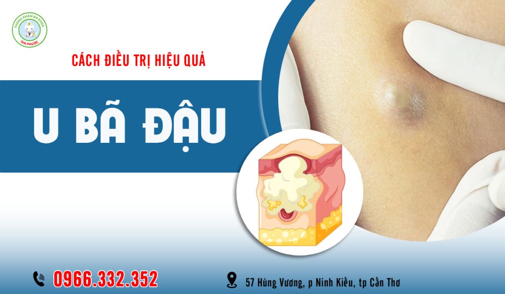 Nhận biết và điều trị u bã đậu dưới da hiệu quả