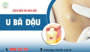 Nhận biết và điều trị u bã đậu dưới da hiệu quả