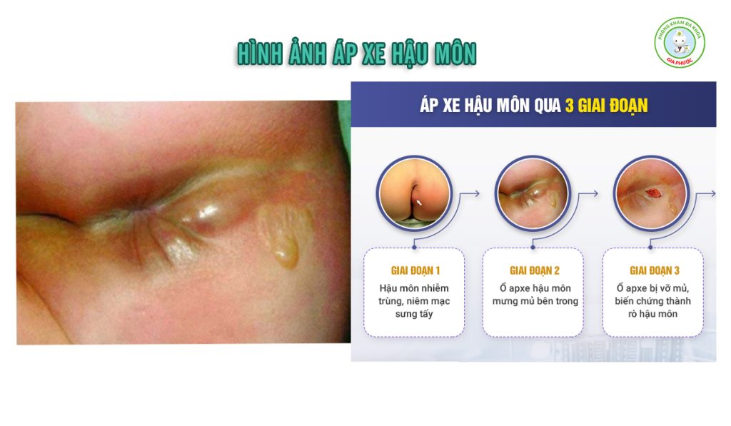 Áp Xe Hậu Môn Có Tự Khỏi Không? Giải Đáp Chuẩn Y Khoa & Cách Điều Trị Hiệu Quả 2 Hình ảnh áp xe hậu môn dễ nhận biết