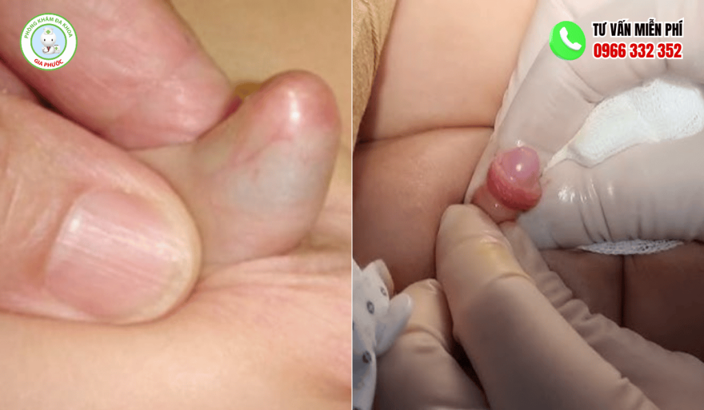 Bao quy đầu trẻ em bình thường và bất thường