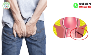 Hình ảnh bệnh mạch lươn