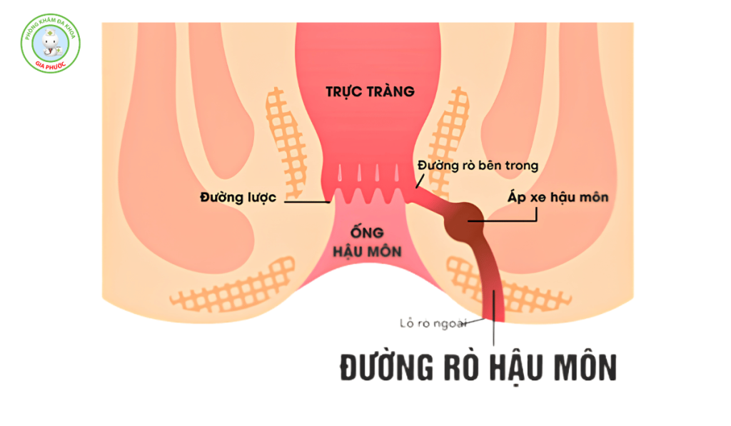 Hình ảnh bệnh mạch lươn