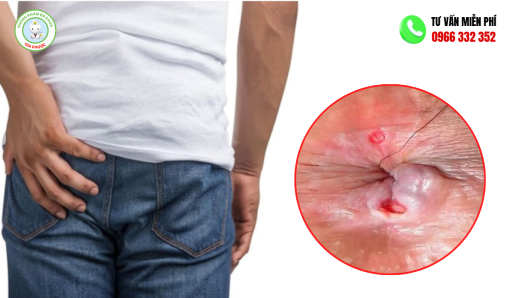 Hình ảnh bệnh mạch lươn