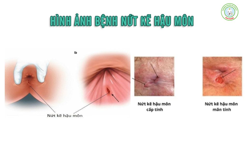 Điều Trị Nứt Kẽ Hậu Môn: Phương Pháp Chuẩn Y Khoa, Nhanh Lành & Hạn Chế Tái Phát 2 Hình ảnh bệnh nứt kẽ hậu môn