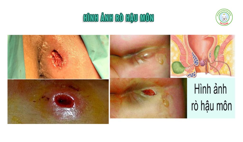 Mổ Rò Hậu Môn Bao Lâu Thì Quan Hệ Được? Lời Khuyên Chuẩn Y Khoa 2 Một số hình ảnh bệnh rõ hậu môn