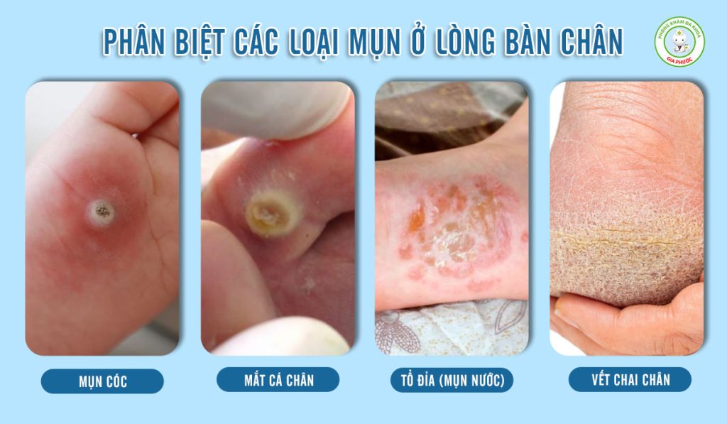 Hình ảnh các loại mụn ở lòng bàn chân