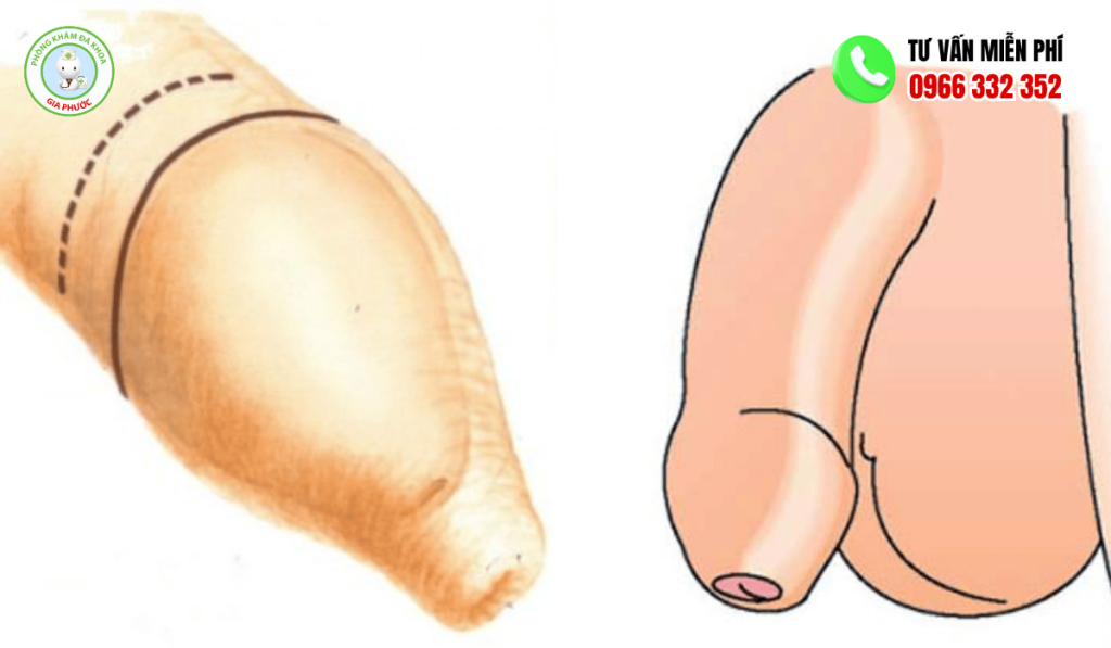 Hình Ảnh Dài Bao Quy Đầu Ở Người Lớn Và Trẻ Em 3 Hình ảnh dài bao quy đầu ở người lớn