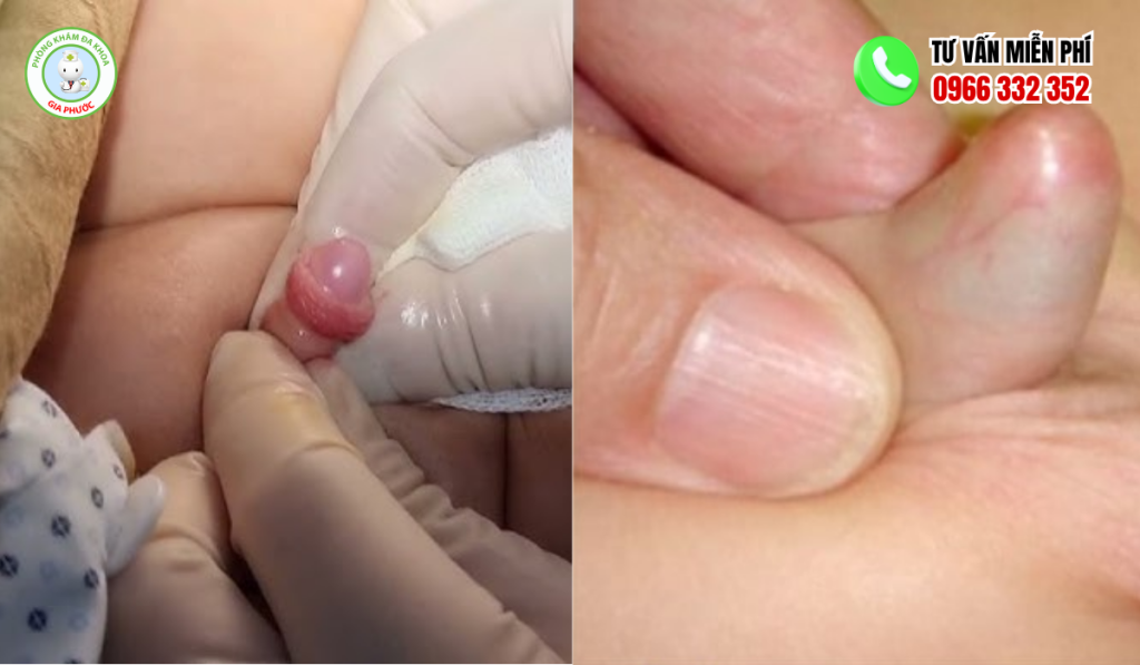 Hình Ảnh Dài Bao Quy Đầu Ở Người Lớn Và Trẻ Em 2 Hình ảnh dài bao quy đầu ở trẻ