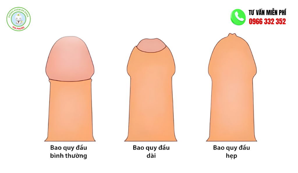 Hình Ảnh Bao Quy Đầu Bình Thường: Dài, Hẹp, Viêm Ở Người Lớn 3 Hình Ảnh Bao Quy Đầu Bình Thường: Dài, Hẹp, Viêm Ở Người Lớn