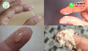 Hình ảnh khí hư bất thường