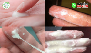 Hình ảnh khí hư màu trắng sữa