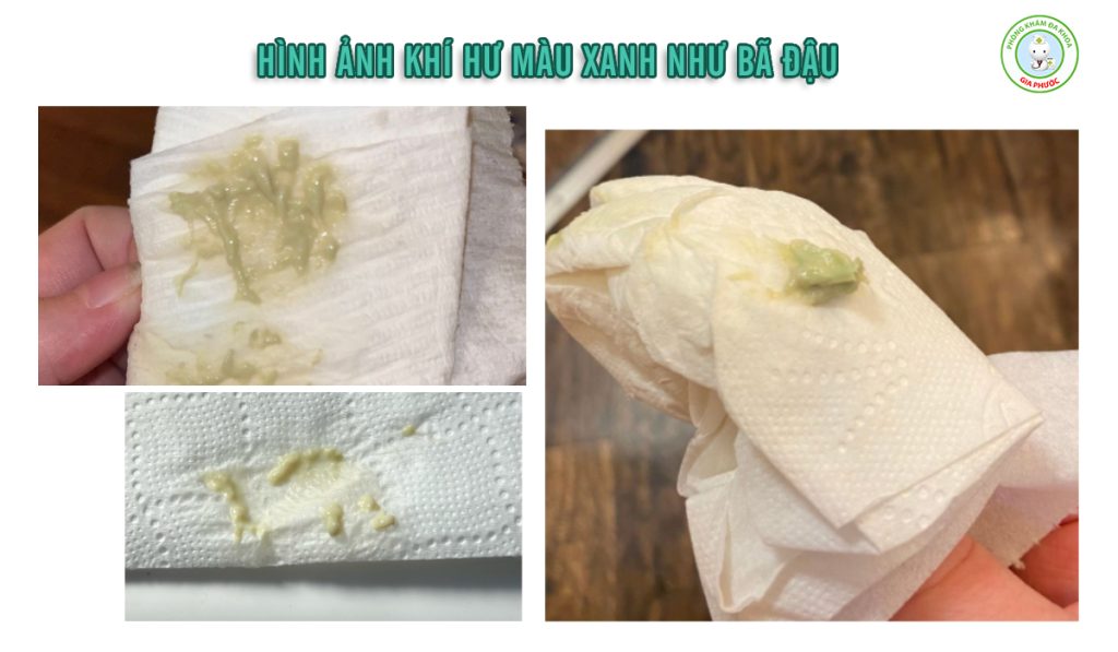 Khí Hư Màu Xanh Như Bã Đậu: Nguyên Nhân, Mức Độ Nguy Hiểm & Cách Điều Trị Hiệu Quả 2 Hình ảnh khí hư màu xanh như bã đậu cảnh báo một số bệnh nguy hiểm