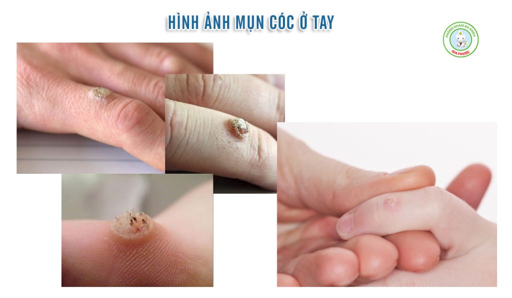 Hình ảnh mụn cóc ở tay