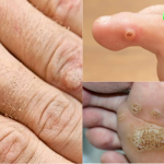 Hình ảnh mụn cóc ở tay, chân. mặt