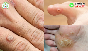 Hình ảnh mụn cóc ở tay, chân. mặt