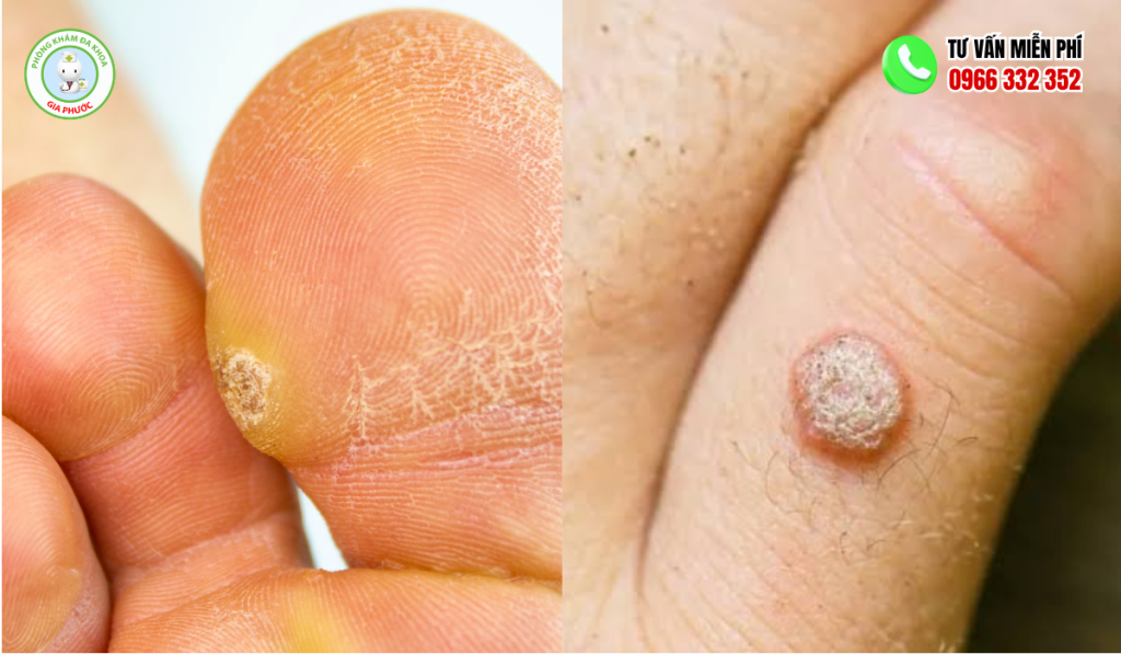 Hình ảnh mụn cóc ở tay, chân. mặt