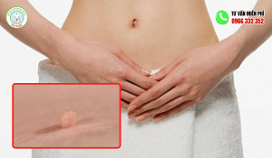 Hình ảnh mụn cóc sinh dục nữ