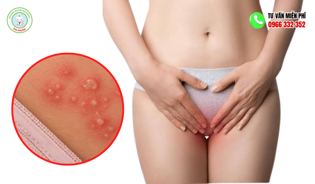 Hình Ảnh Mụn Cóc Sinh Dục Nữ Chi Tiết & Dấu Hiệu Nhận Biết 4 Hình ảnh mụn cóc sinh dục ở nữ qua các giai đoạn