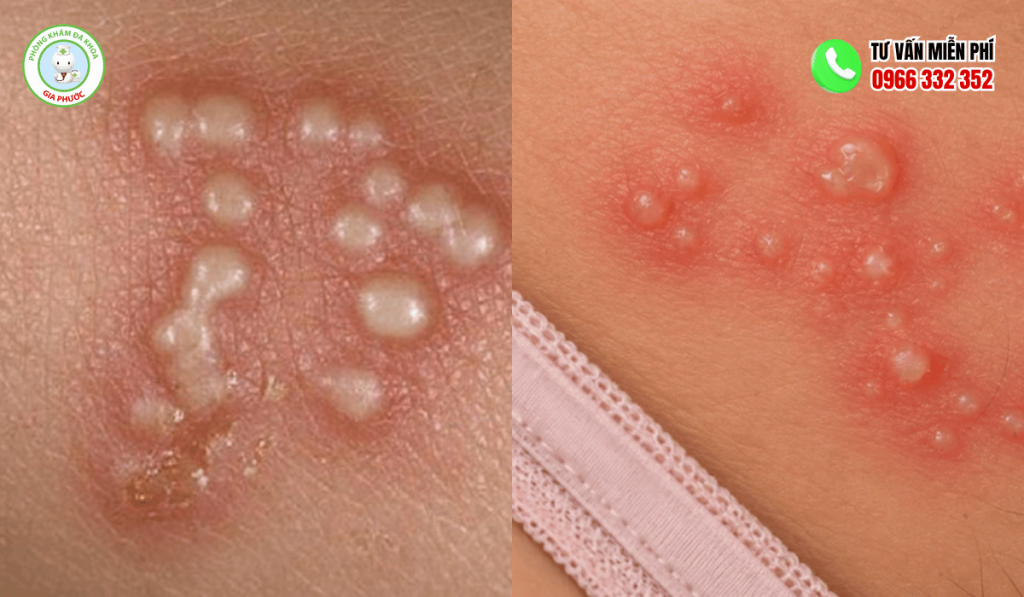 Hình Ảnh Mụn Cóc Sinh Dục Nữ Chi Tiết & Dấu Hiệu Nhận Biết 2 Hình ảnh mụn cóc sinh dục ở nữ qua các giai đoạn