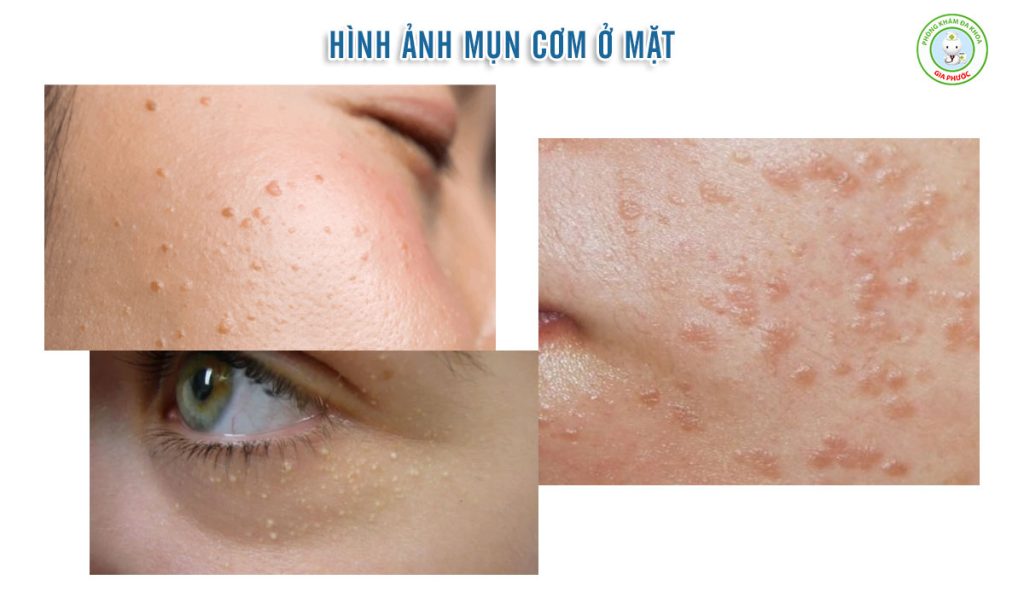 Hình ảnh mụn cơm ở mặt dễ dàng nhận biết