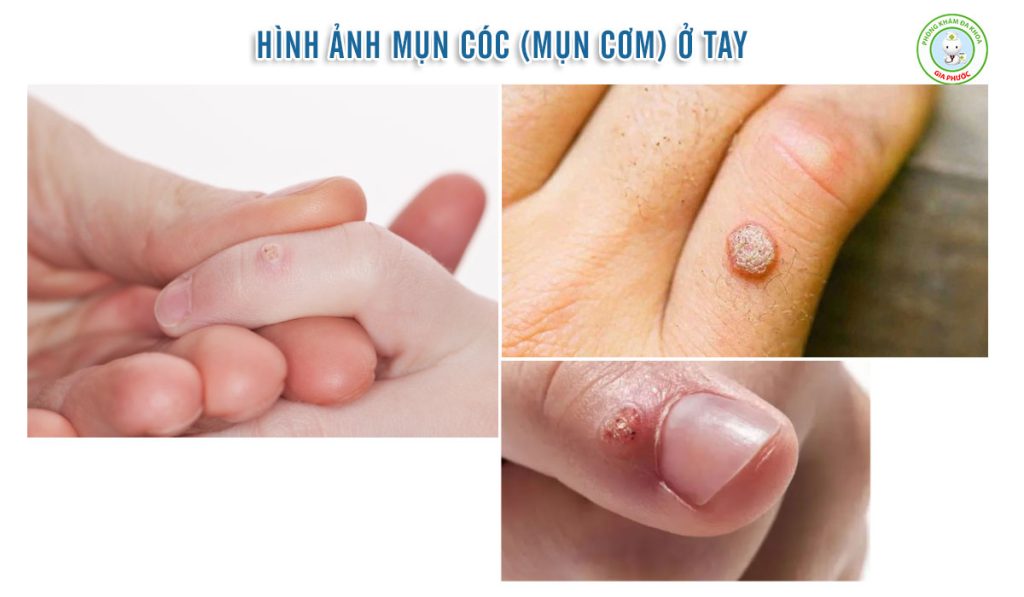 Nhận biết mụn cơm ở tay qua hình ảnh thực tế